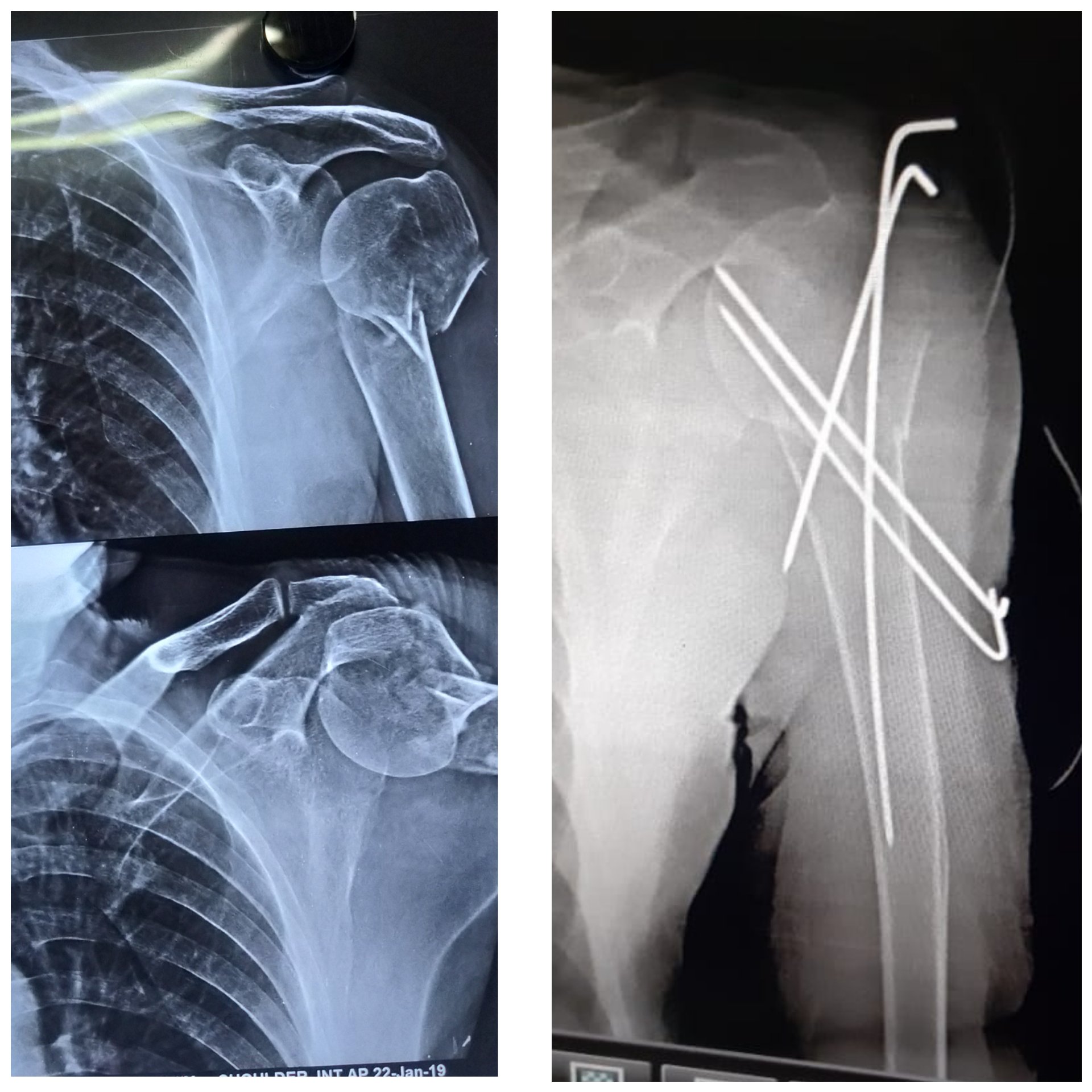 Shoulder fracture X-ray before and after surgery – Dr. Thulasi Ram