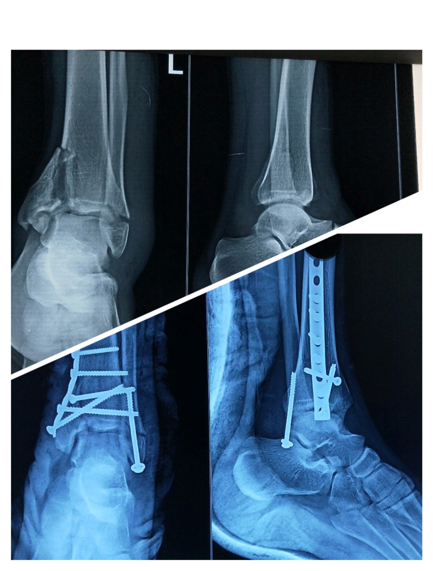 Ankle fracture X-ray before and after surgery – Dr. Thulasi Ram