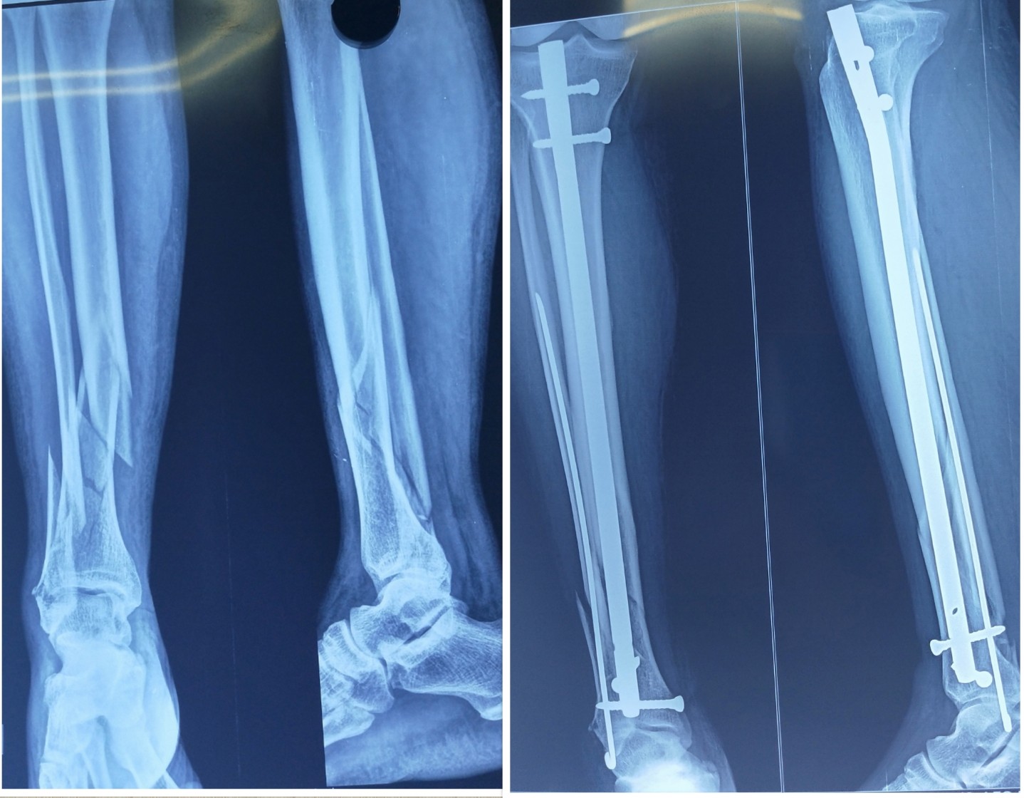 Both bone leg fracture X-ray before and after surgery – Dr. Thulasi Ram